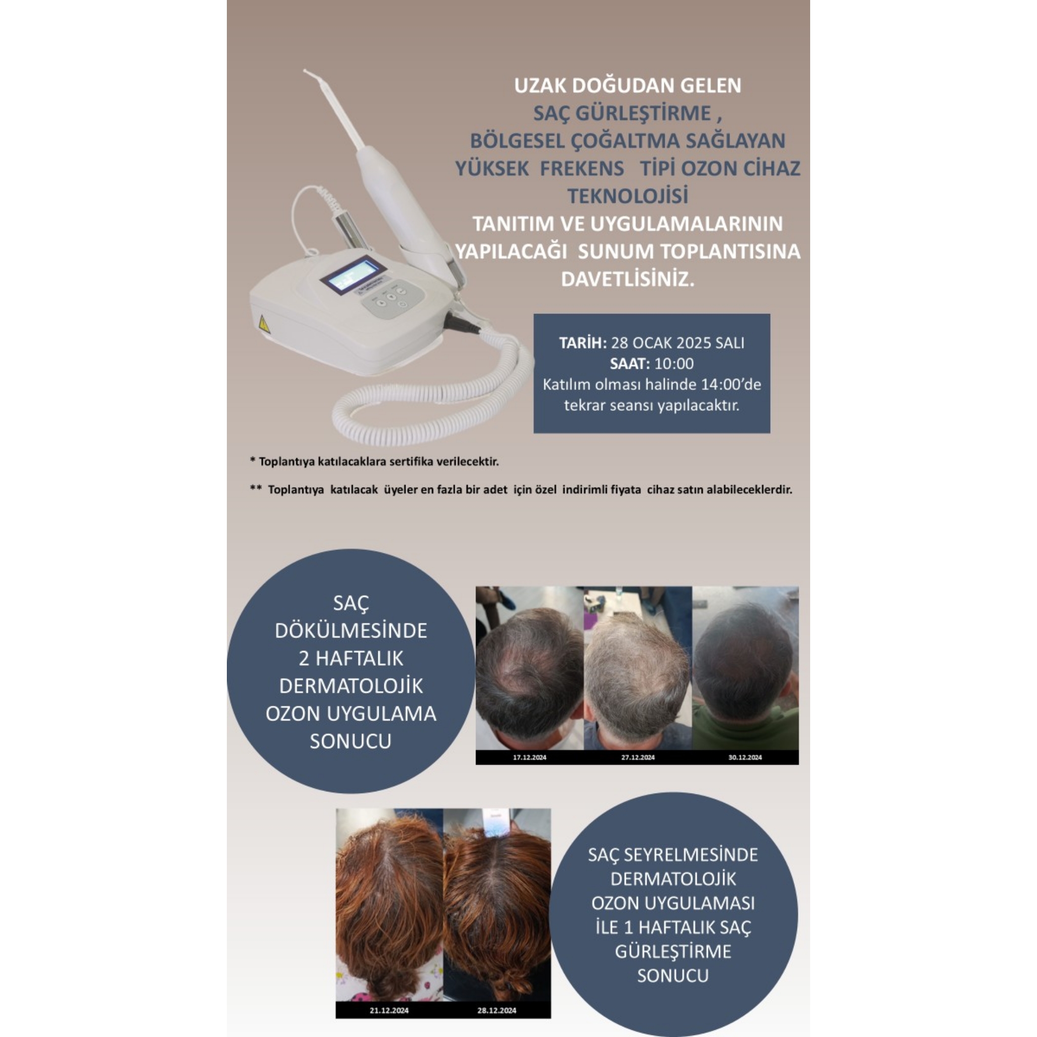 SAÇ DÖKÜLMESİNDE OZON UYGULAMASI HAKKİNDA